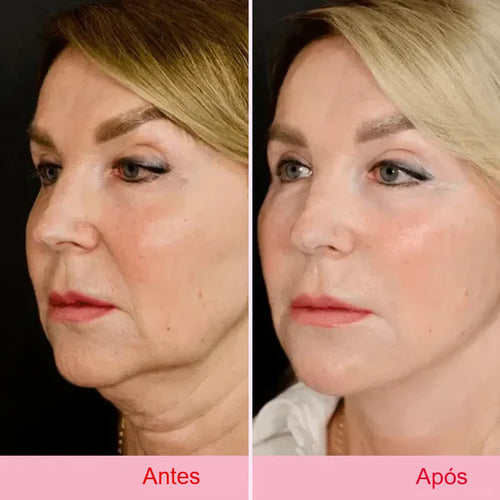 Fita adesiva para lifting facial invisível V-Face Anti Rugas