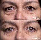 Adesivos Antirrugas Reutilizáveis Linhas De Expressão Para Rosto Olhos Pescoço e Colo