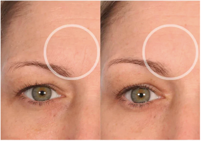 Adesivos Antirrugas Reutilizáveis Linhas De Expressão Para Rosto Olhos Pescoço e Colo