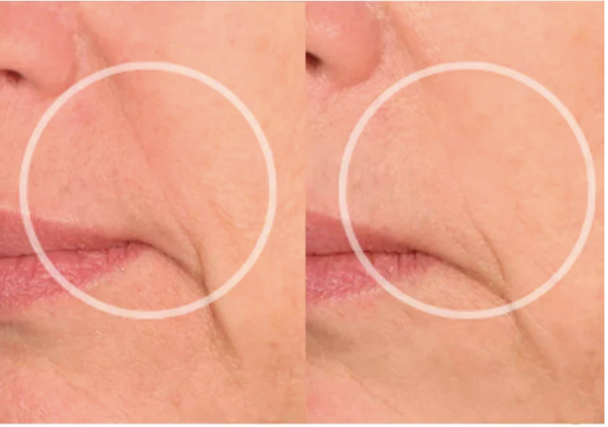 Adesivos Antirrugas Reutilizáveis Linhas De Expressão Para Rosto Olhos Pescoço e Colo